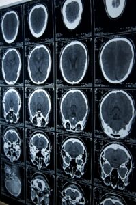 brain injury attorney in Savannah, Georgia