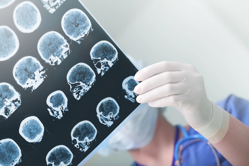 Four Leading Causes Of Traumatic Brain Injuries