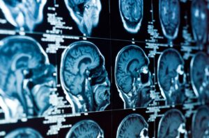 Brain Injury Statistics in Savannah