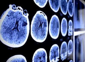 Why Choose Chattahoochee Injury Law for Brain Injury Cases in Savannah, Georgia